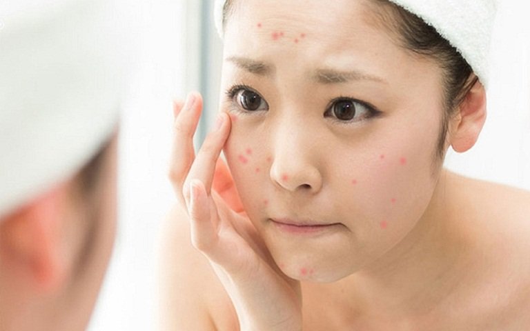 Niacinamide hiệu quả cao trong việc sáng da và hỗ trợ điều trị mụn